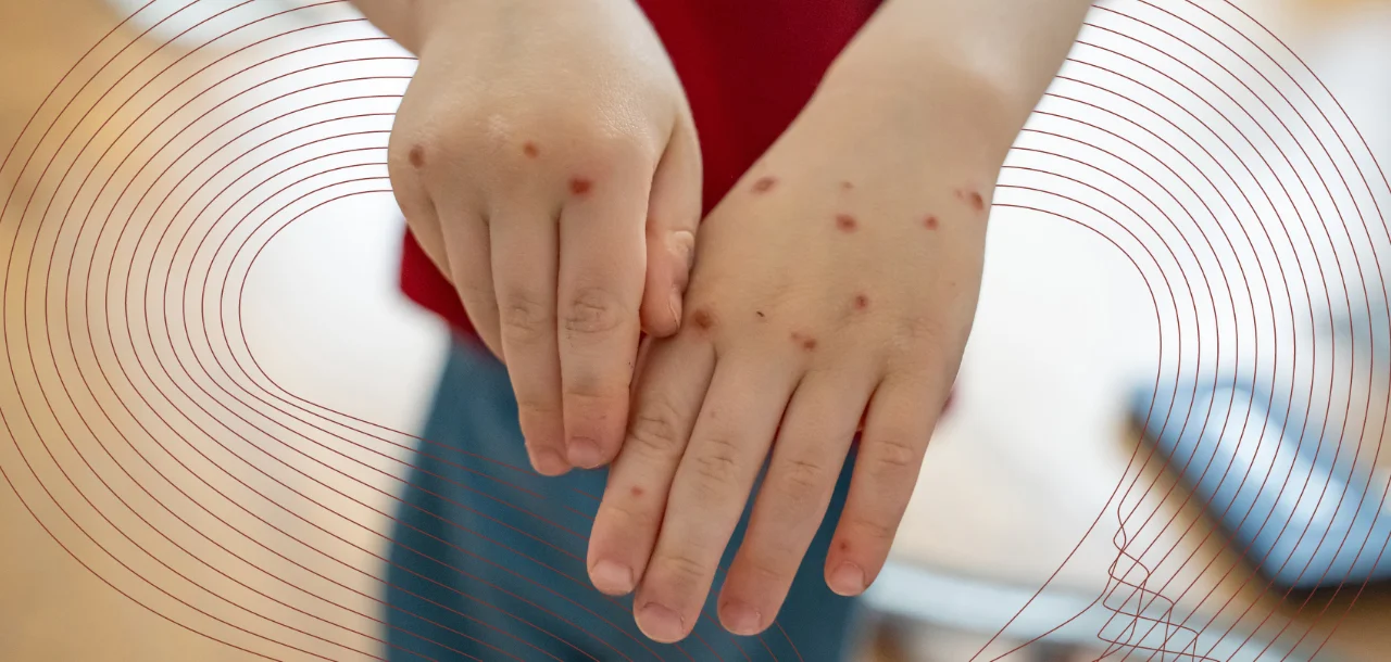 sintomas de meningite em crianças